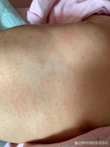 宝宝酒精过敏症状_酒精过敏图片怎么看