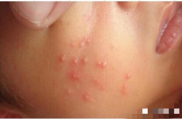 宝宝长痘痘有几种图片_新生儿痤疮和湿疹区别图