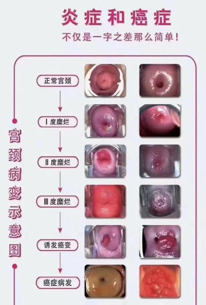 宫颈图片大全_正常与病变对比图怎么看