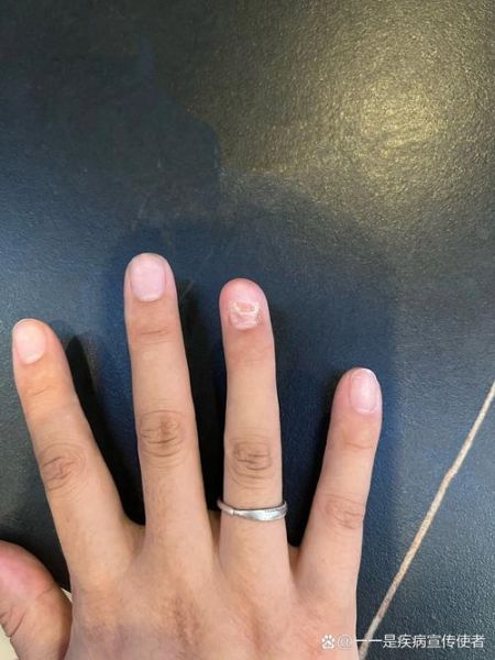 梦到指甲掉了是什么意思_梦到指甲掉了预示什么