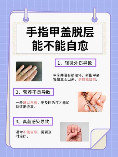 梦到指甲掉了是什么意思_梦到指甲掉了预示什么