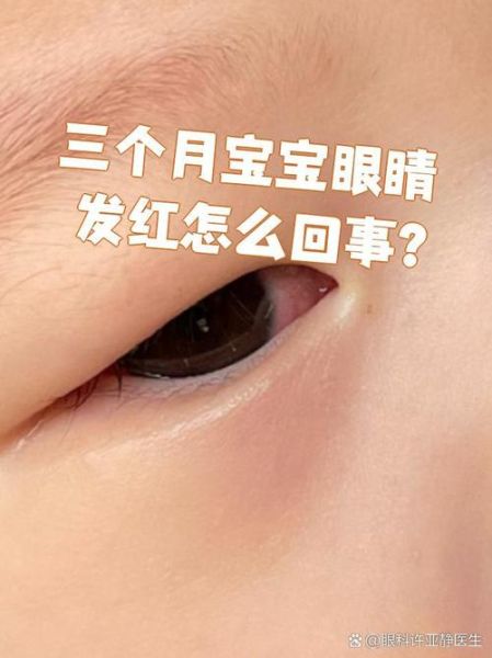 宝宝眼角发红是什么原因_怎么处理