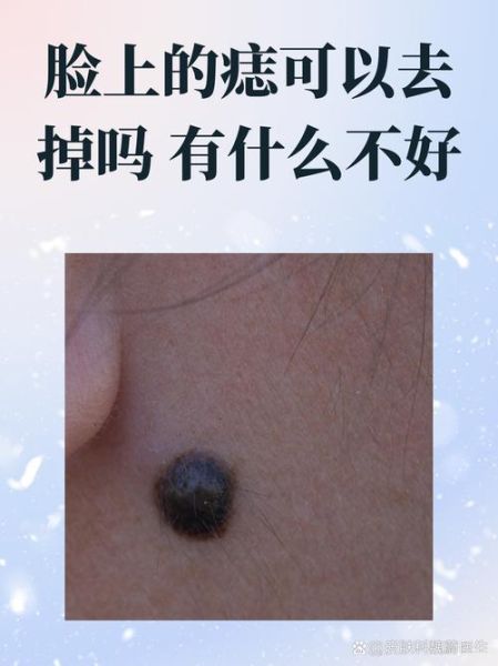 2岁宝宝脸上为什么突然长痣_婴儿色素痣会自己消失吗