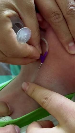 宝宝抽静脉血的危害_婴儿静脉抽血风险