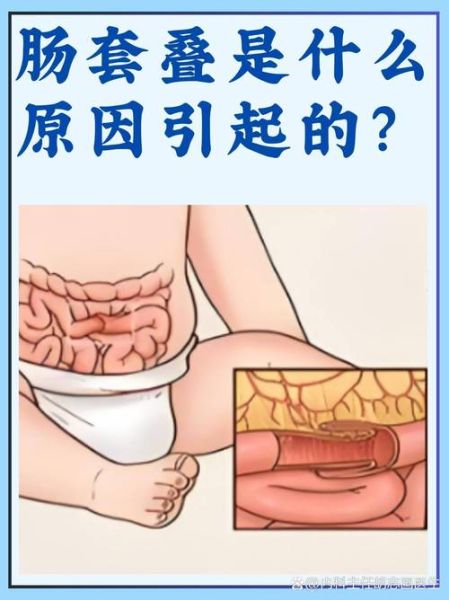 宝宝肠套叠怎么治疗_肠套叠会自愈吗