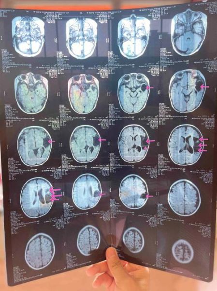 核磁共振对宝宝有影响吗_婴儿做MRI安全吗