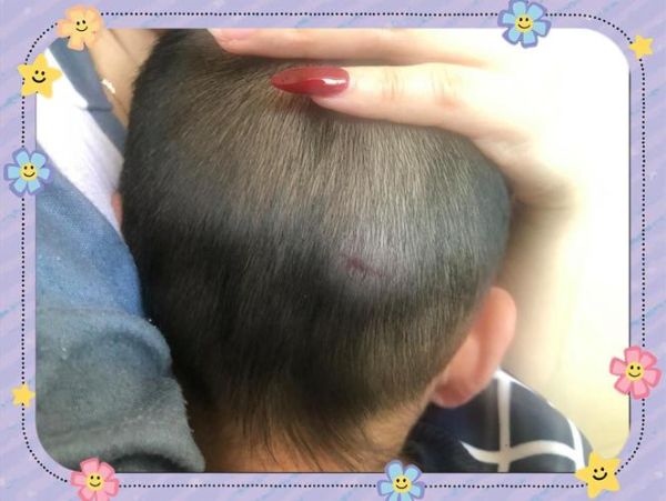 1岁半宝宝摔到后脑勺怎么办_需要去医院吗