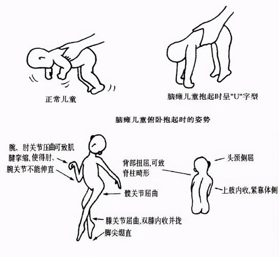 宝宝脑瘫早期症状有哪些_八个动作筛查图怎么看