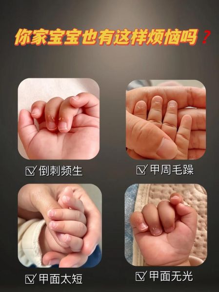 宝宝手上倒刺怎么办_如何预防宝宝倒刺