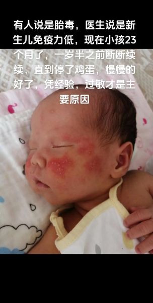 宝宝头上起湿疹怎么办_婴儿头皮湿疹怎么护理