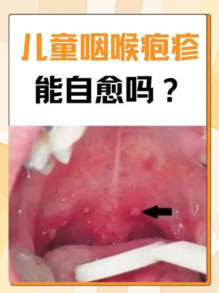 宝宝喉咙长泡发烧怎么办_喉咙疱疹反复高烧