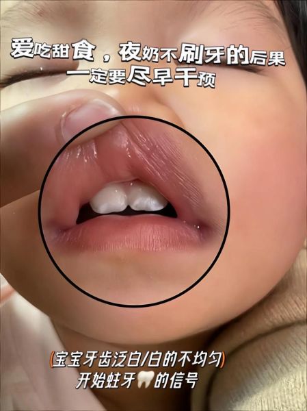 14个月宝宝牙齿有白斑怎么办_宝宝牙齿白斑会掉吗