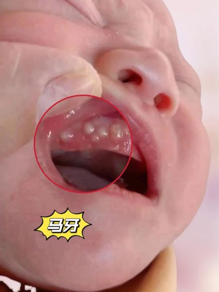 五个月宝宝长马牙怎么办_马牙会自己消失吗