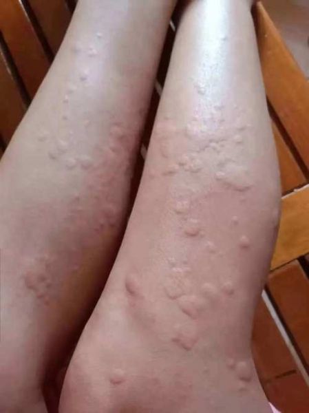 荨麻疹图片大全_荨麻疹初期症状图片