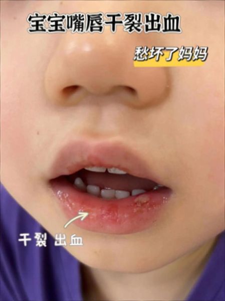 宝宝嘴上湿疹怎么办_宝宝嘴上湿疹小妙招