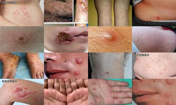 梅毒初期症状图片_梅毒皮疹图片大全