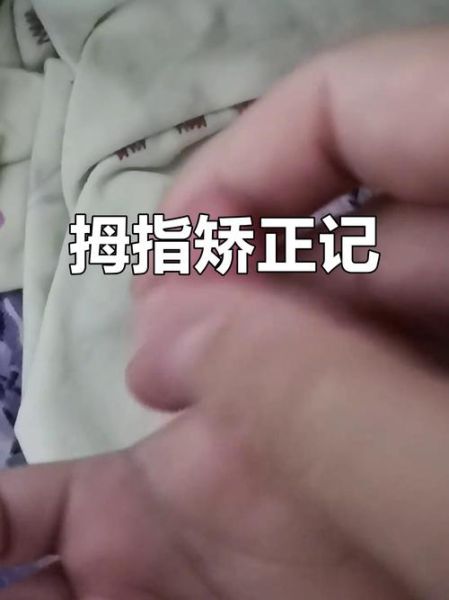 宝宝大拇指伸不直_需要看医生吗