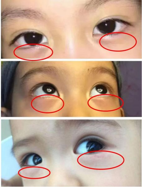 宝宝眼角发青怎么回事_宝宝眼角发青正常吗