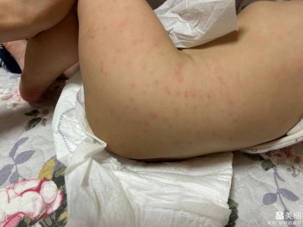 宝宝大腿外侧起红疹子怎么办_婴儿大腿外侧红疹子原因