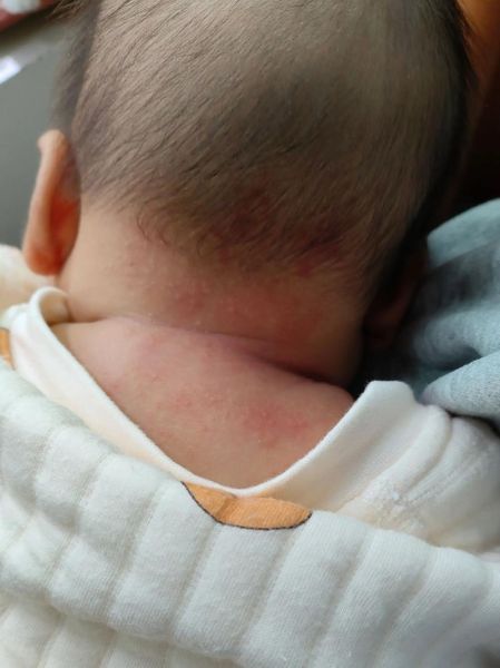 宝宝身上长小疙瘩怎么办_婴儿皮肤小疙瘩图片对照