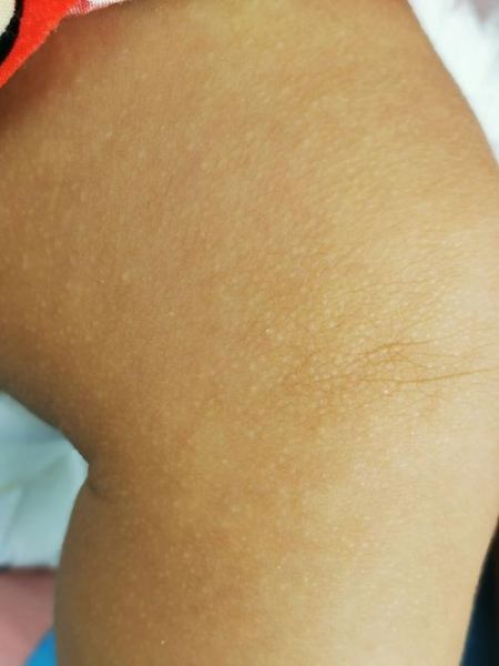 宝宝身上长小疙瘩怎么办_婴儿皮肤小疙瘩图片对照