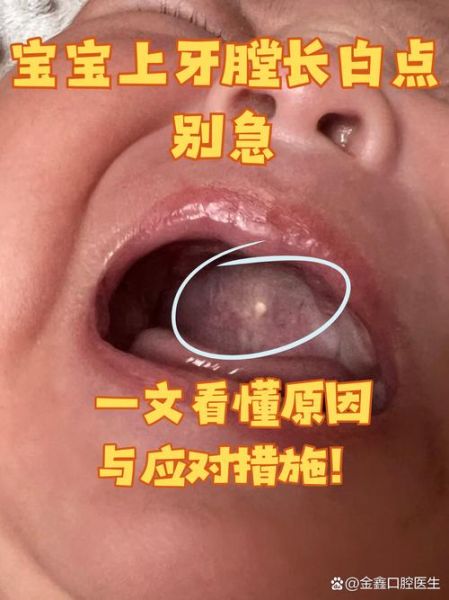 宝宝牙齿有白斑怎么办_如何预防宝宝牙齿白斑