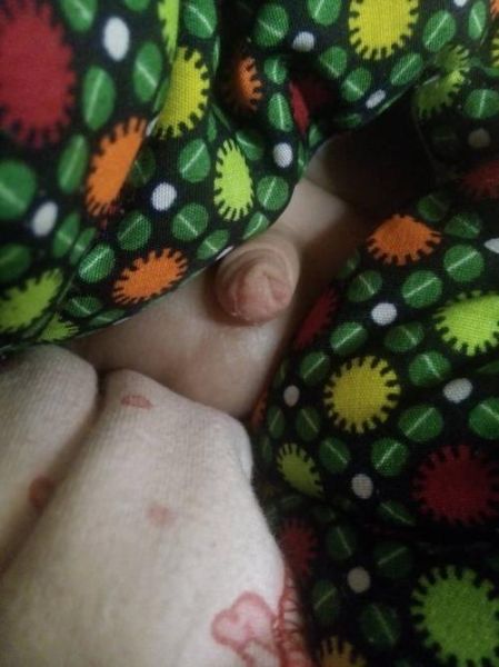 宝宝小鸡头红肿怎么办_婴儿龟头红肿原因