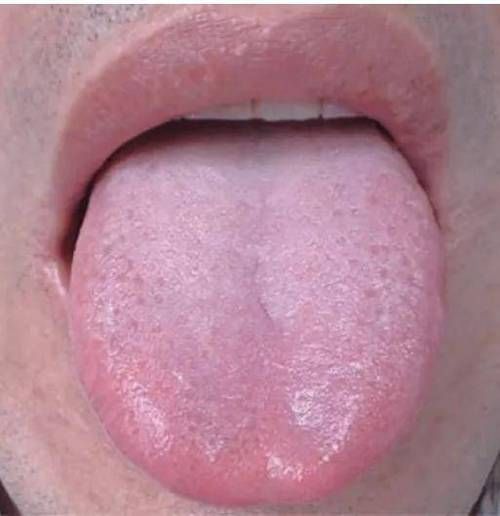 舌头背面正常图片大全_正常舌背是什么样