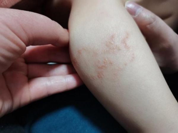 宝宝腿纹不对称图片怎么看_腿纹不对称正常吗