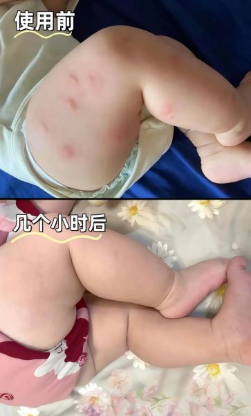 宝宝身上长包怎么回事_宝宝身上长包怎么办