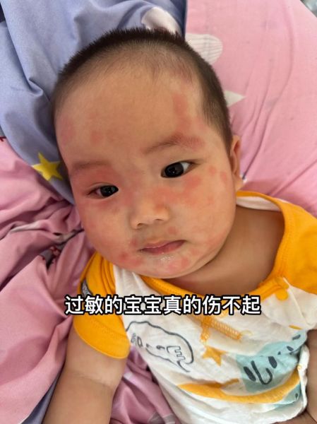 五个月宝宝过敏怎么办_五个月宝宝过敏症状有哪些