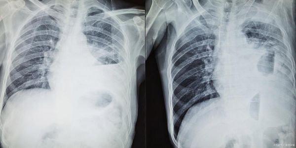 宝宝胸片怎么看_拍胸片对婴儿有影响吗