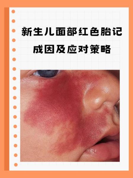 宝宝脸上红色胎记怎么去除_宝宝红色胎记会自己消失吗