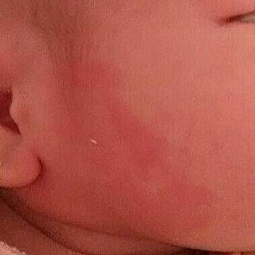 宝宝脸上红色胎记怎么去除_宝宝红色胎记会自己消失吗