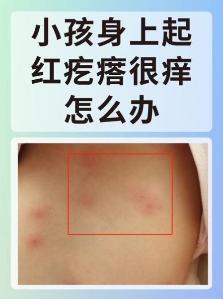 七个月宝宝起红疙瘩图_宝宝红疙瘩怎么办