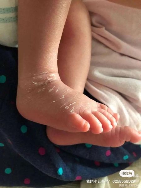一岁半宝宝脚脱皮怎么办_脚脱皮是缺什么