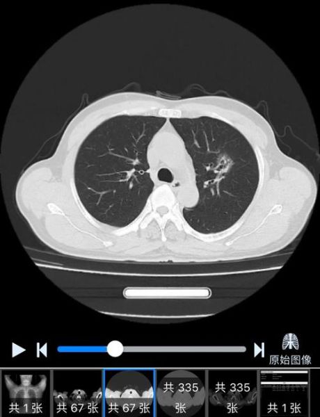 肺图片大全_肺部CT怎么看