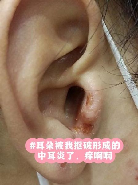 中耳炎宝宝症状_中耳炎宝宝能自愈吗