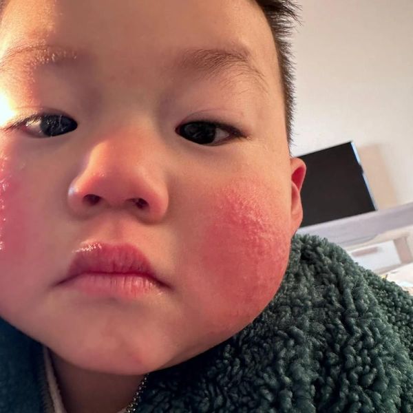 1岁半宝宝脸上长小红疙瘩怎么办_脸上小红疙瘩是什么