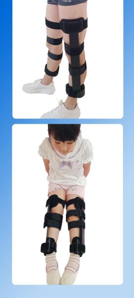 宝宝o型腿怎么矫正_婴儿罗圈腿矫正方法