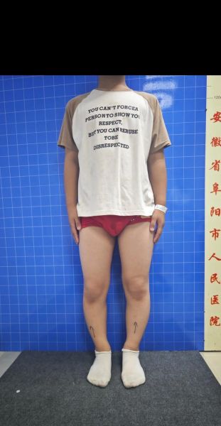宝宝o型腿怎么矫正_婴儿罗圈腿矫正方法