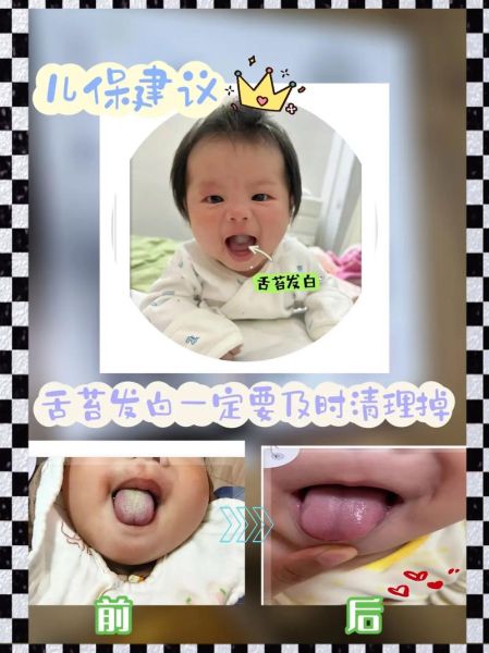 吃母乳的宝宝舌苔发白怎么回事_需要看医生吗