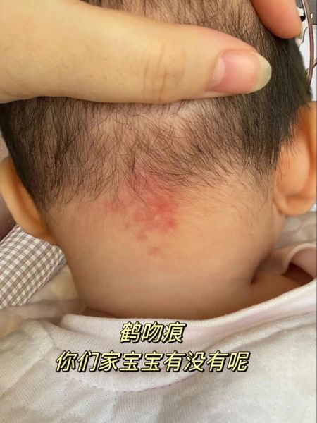 宝宝后脑勺鹤吻痕图片_新生儿红斑多久消退