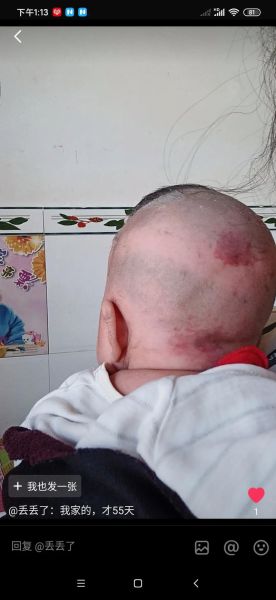 宝宝后脑勺鹤吻痕图片_新生儿红斑多久消退