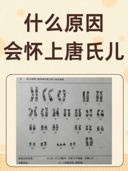 唐宝宝是什么意思_唐氏综合征儿童特征