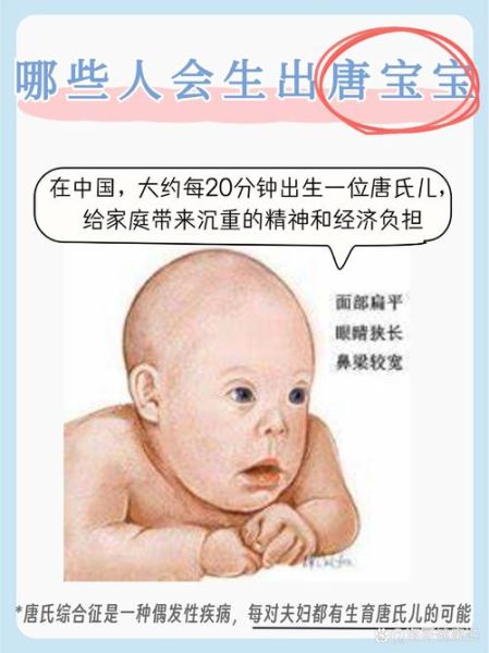 唐宝宝是什么意思_唐氏综合征儿童特征