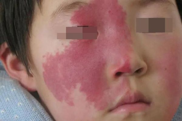 胎记图片大全_胎记类型有哪些