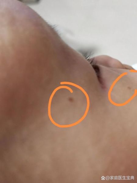 宝宝脸上长黑点怎么办_宝宝脸上黑点会自己消失吗