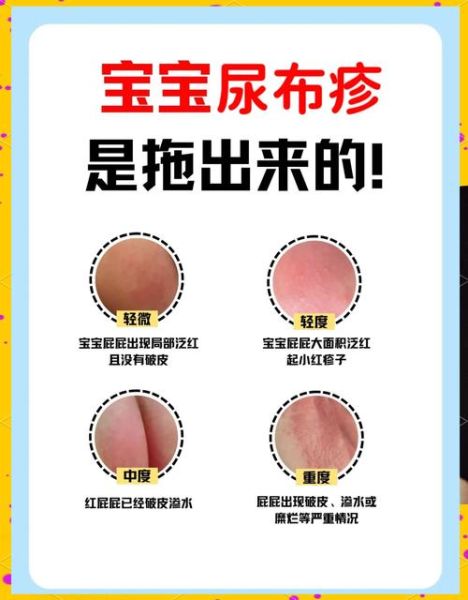 宝宝红屁股怎么办_尿布疹快速止痒方法