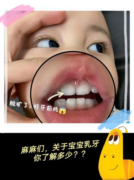 宝宝牙齿缺口怎么回事_宝宝牙齿缺口怎么办